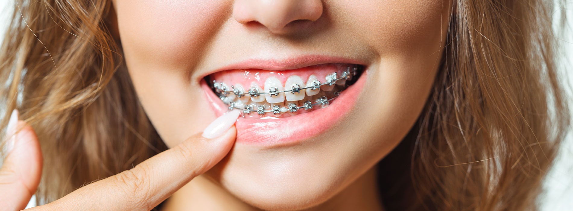 A young woman with braces smiling broadly at the camera.